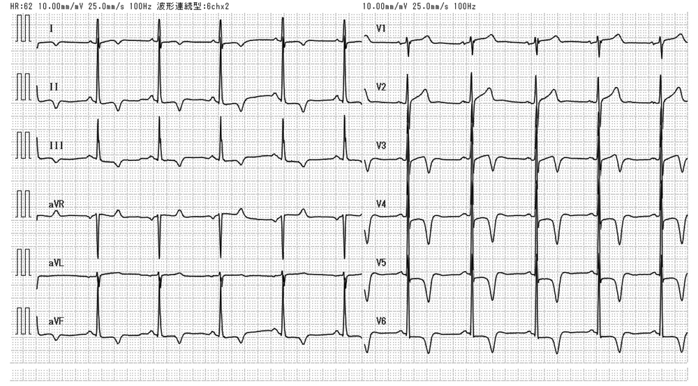 心電図波形 非特異的t波異常 検査 診断matrix